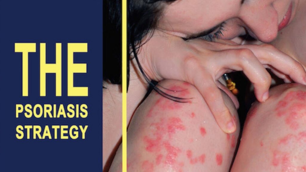 The Psoriasis Strategy
