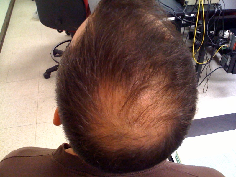 Female Hair Loss Treatment
